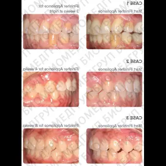 Зубная форма для выравнивания зубов iFinisher