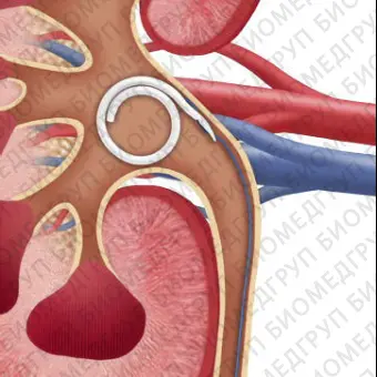 Мочеточниковый стент JFil MiniJFil