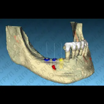 Программное обеспечение для стоматологической имплантологии BTI Scan 3