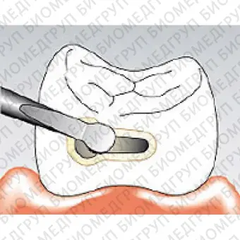 Sonicflex micro  набор насадок для препарирования малых полостей и скашивания краев эмали