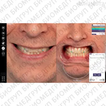 Exocad Smile Creator  модуль для планирования улыбки