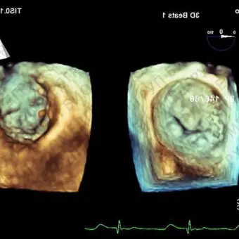 Philips EPIQ CVx Аппарат УЗИ