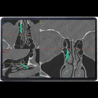 Система хирургической навигации для хирургической отоларингологии Navient ENT