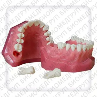 Модель верхней и нижней челюстей с 28 интактными зубами для удаления