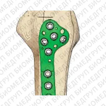 Компрессионная костная пластина плечевая кость P.R.C.T II