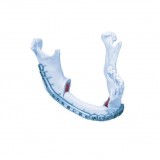 Компрессионная костная пластина для нижней челюсти MatrixMANDIBLE™