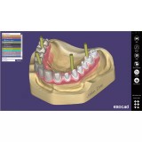 Exocad Implant Module - модуль для создания имплантов