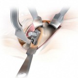 Комплект инструментов для миниинвазивной хиругии тазобедренного сустава MIOS®